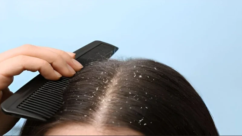 সারা বছর খুশকির সমস্যা? জেনে নিন ঘরোয়া সমাধান