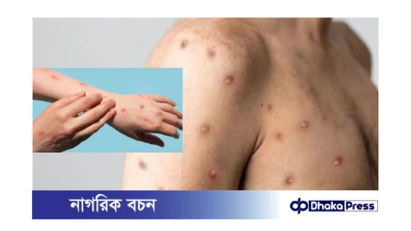 মাঙ্কিপক্স: সতর্ক থাকুন এই মারণ রোগ থেকে