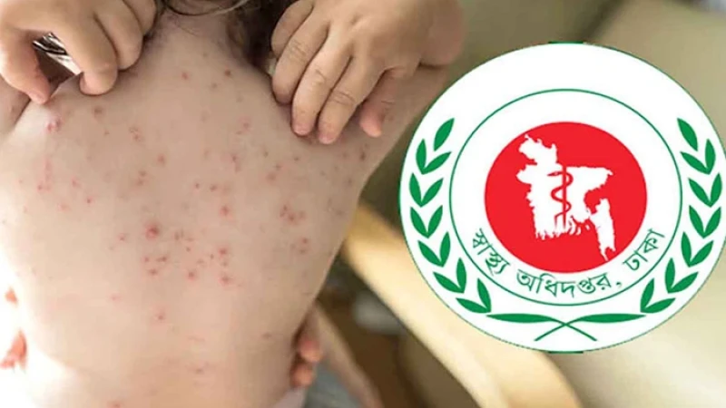 হাম ও হামের উপসর্গ নিয়ে আরও ৭ জনের মৃত্যু