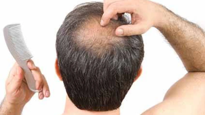 অল্প বয়সে টাক পড়া আটকাতে ঘরোয়া কিছু উপায়