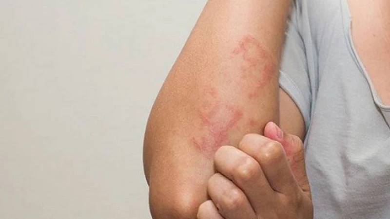 ছারপোকার ফলে কি কি শারীরিক সমস্যা হতে পারে