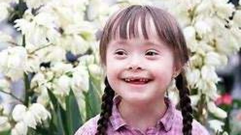 ডাউন সিনড্রোম শিশু নানা ত্রুটি নিয়ে জন্মায়, লক্ষণ ও করণীয়