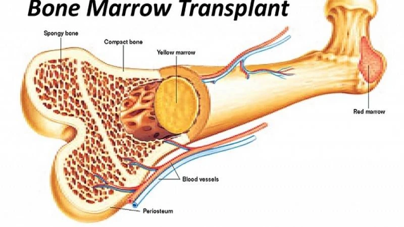 বিএসএমএমইউতে বোনম্যারো ট্রান্সপ্লান্টেশন সেন্টার চালু