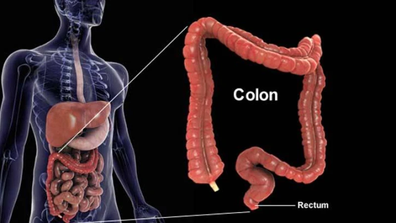 পরিবারে কোলন ক্যানসারের ইতিহাস থাকলে কি করণীয় ?