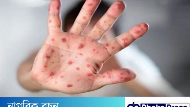 ইউরোপে হামের প্রাদুর্ভাব বেড়েছে ৪৫ গুণঃ ডব্লিউএইচও