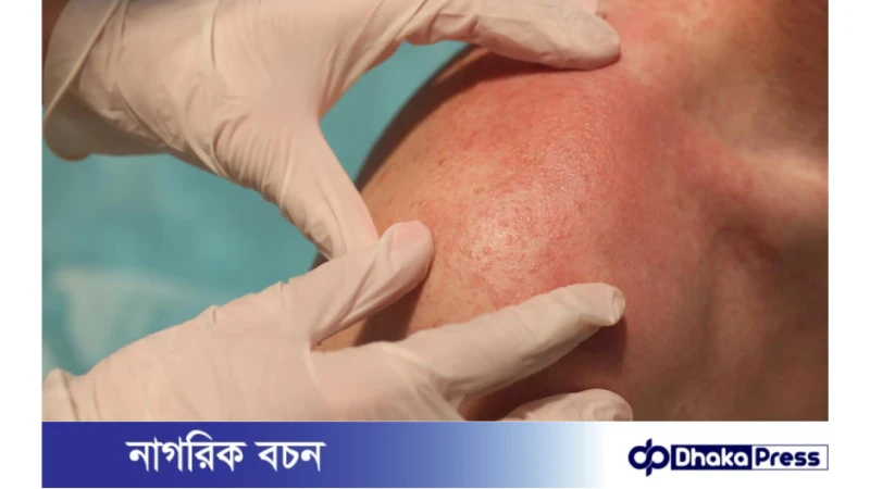 সান অ্যালার্জি এড়ানোর উপায়