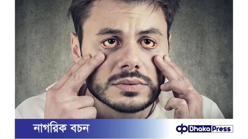 তীব্র গরমের বাড়ে জন্ডিসের উপসর্গ