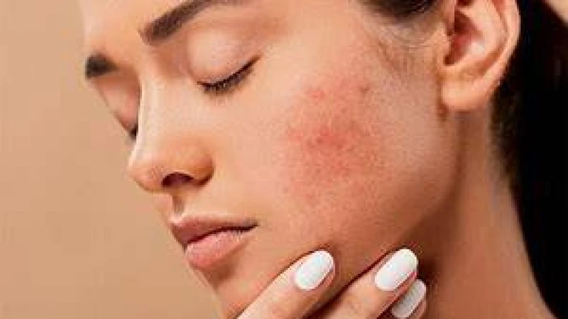 ব্রণ সমস্যা আর নয়