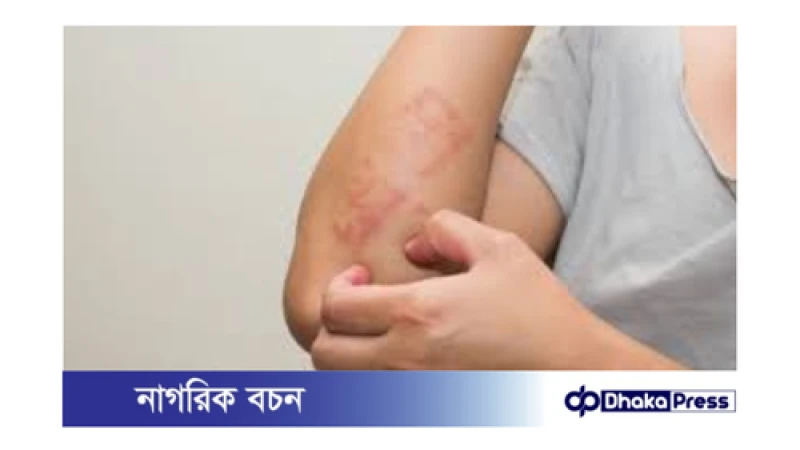 বর্ষায় চর্মরোগ বৃদ্ধির কারণ: