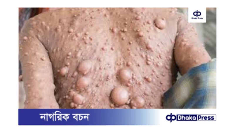 নিউরোফাইব্রোম্যাটোসিসের তিনটি প্রধান ধরণ রয়েছে: